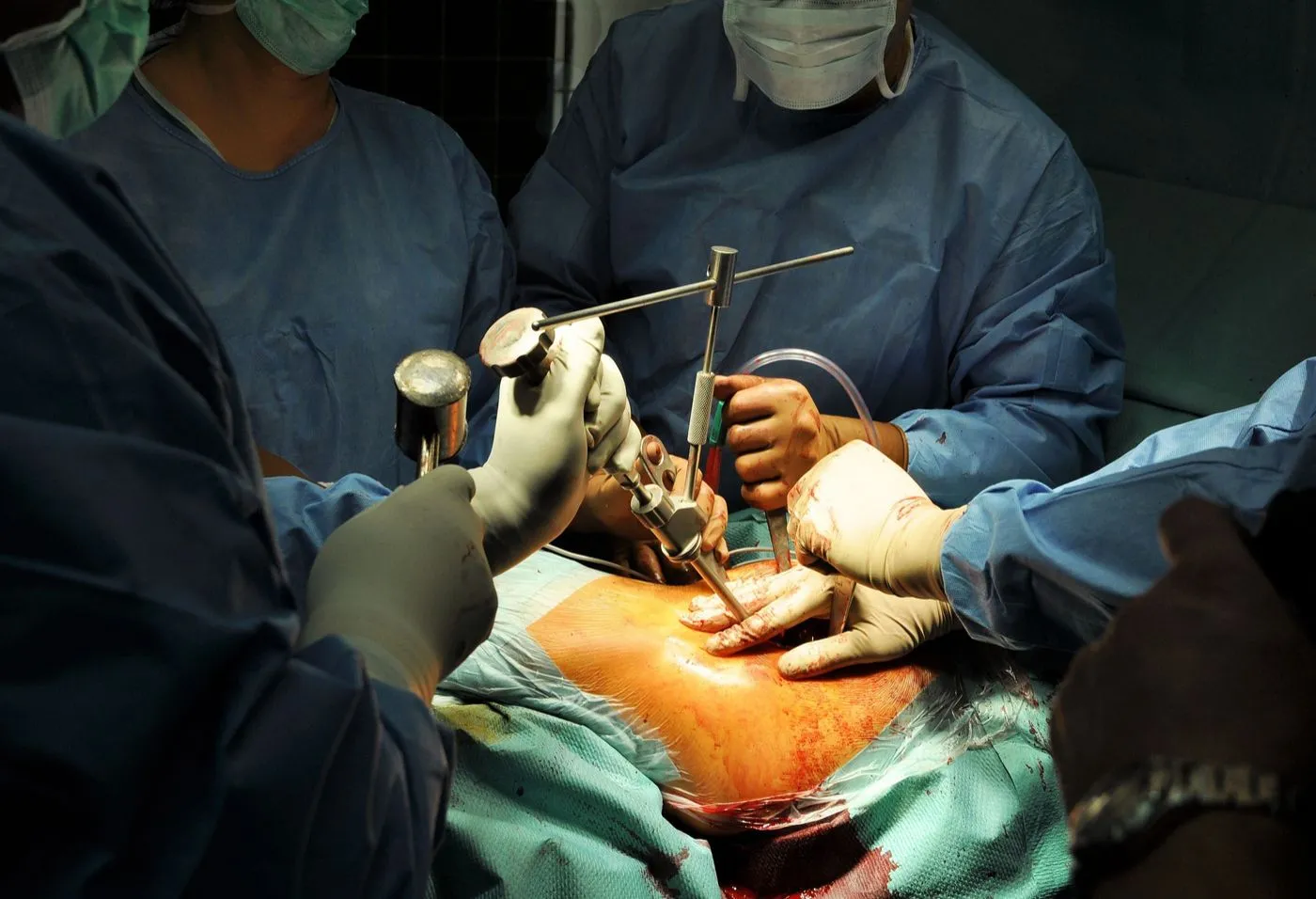 Fracture and trauma treatment in progress in Ranchi
